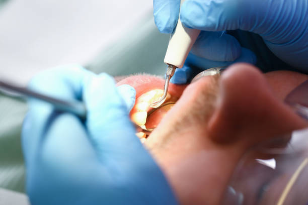 Best Knocked-Out Tooth (Avulsed Tooth) Treatment in Csar Chvez, TX